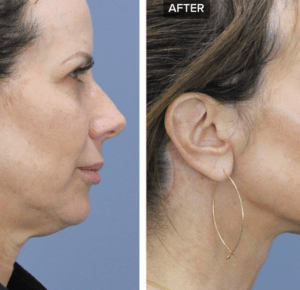 Understanding Neck Lift Surgery - Costs and Considerations