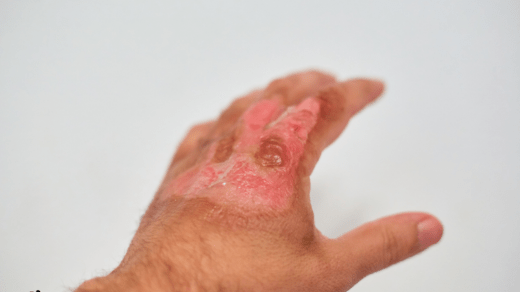 treatment of burn injury in Coimbatore