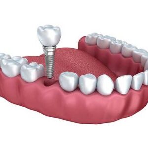 dental implants in Pleasantville