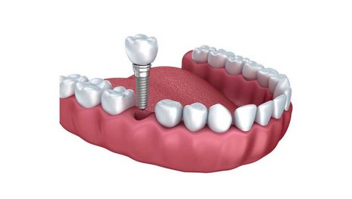 dental implants in Pleasantville