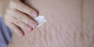 Stretch Mark Struggle