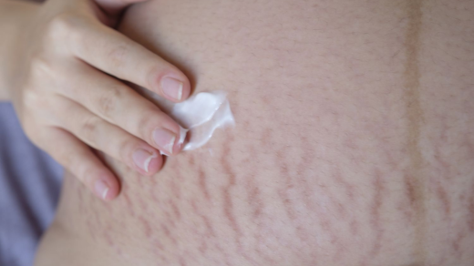Stretch Mark Struggle