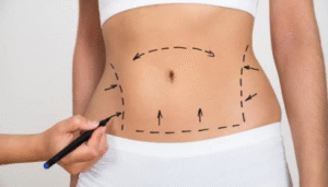 tummy tuck in Atlanta